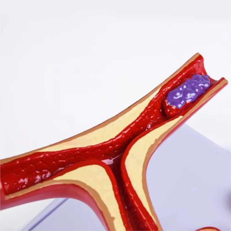 10-Кратное Увеличение Артериальной Коронарной артерии Человека, Модель Атеросклероза Коронарных артерий, Модель Поперечного сечения Тромба Сердечных заболеваний Изображение 2