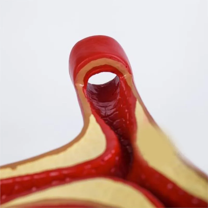 10-Кратное Увеличение Артериальной Коронарной артерии Человека, Модель Атеросклероза Коронарных артерий, Модель Поперечного сечения Тромба Сердечных заболеваний Изображение 3